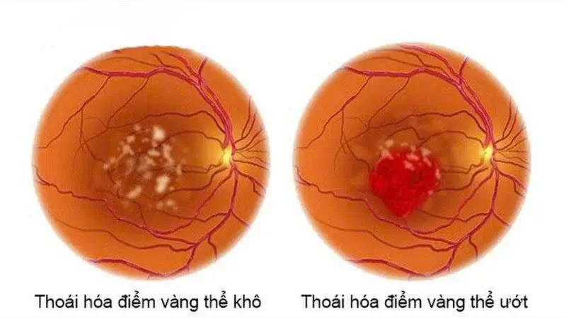 Tác động tiêu cực của ánh sáng xanh đến thị lực